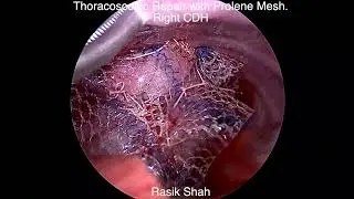 Clip demonstrates thoracoscopic repair with mesh for right congenital diaphragmatic hernia with sac.