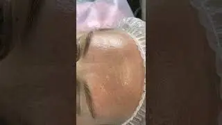 Сложные лобмежбровье. Ставим ботокс и заполняем заломы. 