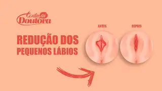 A cirurgia íntima feminina - Ninfoplastia