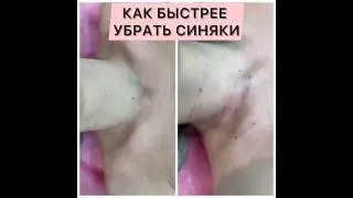 СИНЯКИ ПОСЛЕ КОСМЕТОЛОГИЧЕСКИХ ПРОЦЕДУР. 