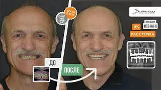 63 года с неправильным прикусом! Анатолий Евгеньевич - имплантация зубов видеоотзыв в Дантистофф