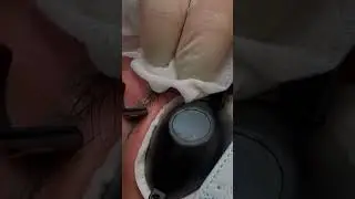 Удаление татуажа
