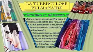Tuberculose finale   1AS4