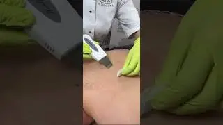 💦НЕСТАНДАРТНО: УЗ-чистка спины