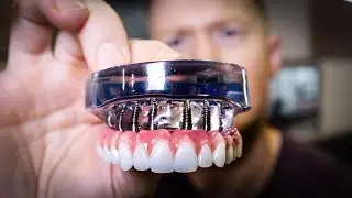 DENTURES vs Dental IMPLANTS Full Mouth Rehabilitation - See the Smile Transformation!