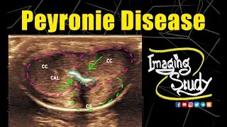 Peyronie Disease || Ultrasound || Case 238