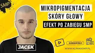 Mikropigmentacja skóry głowy - JACEK - Efekt po zabiegu Mikropigmentacji skóry głowy
