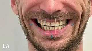 Smile Creator and Digital Wax-up in EXOCAD Case 4