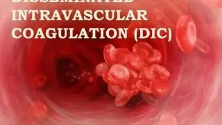 Disseminated Intravascular Coagulation