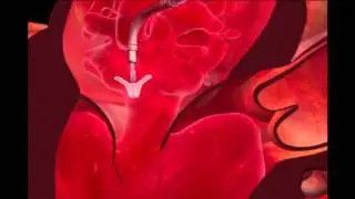 Mitraclip Transcatheter Mitral Valve Repair Procedure Animation