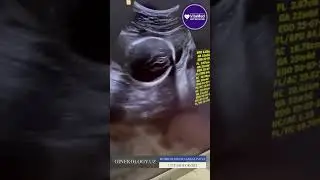 Egizak homiladorlik biri 22 haftalik ikkinchisi 16 haftalik