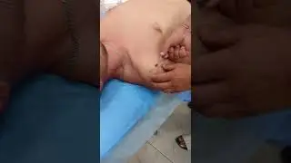 Пчелоужаление в правке живота. Продолжение