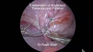 Thoracoscopic plication of diaphragm  for eventeration by Dr. Rasik Shah