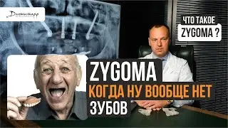 Скуловая имплантация зубов Zygoma Зигома → при полном отсутствии зубов и костной ткани 