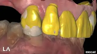 Smile Creator and Digital Wax-up in EXOCAD Case 3