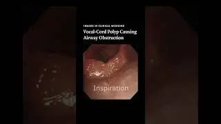Vocal-Cord Polyp Causing Airway Obstruction | NEJM