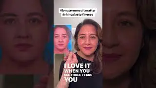 Long-term Results Matter in Rhinoplasty !