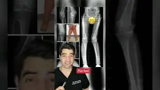 Flat feet can cause arthritis 