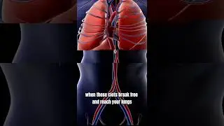 Blood clot in the lungs ✈️ Pulmonary Embolism 🫁