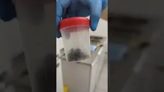 Камушки на память. Камни из желчного пузыря. Видео из операционной 