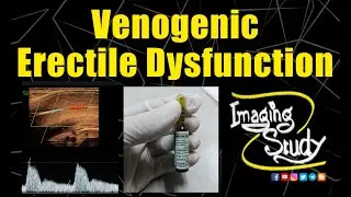 Venogenic Erectile Dysfunction || Ultrasound || Doppler || Case 313