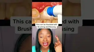 White spots with braces 