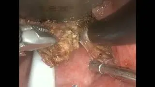 TORS Robotic resection of HPV-related tongue and throat cancer