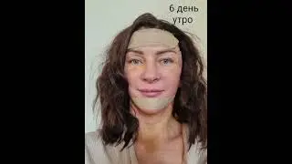 Голливудский фейслифтинг. Подтяжка лица. Пластический хирург Татьяна Романовская