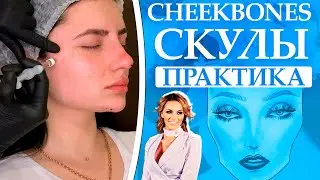 Cheekbones скулы. Контурная пластика филлерами на основе гиалуроновой кислоты.