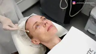 Химический отбеливающий пилинг лица. Chemical whitening face peeling.