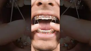 417 days with braces 🤯