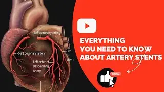 Everything You Need to Know About Artery Stents: Your Ultimate Guide