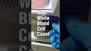 leukocytosis or high WBC count 