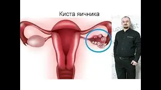 Киста яичника