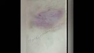 Лечение псориаза холодной плазмой