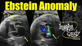 Ebstein Anomaly || Ultrasound || Fetal Echo || Case 345