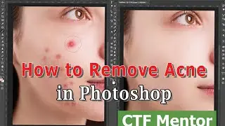 How to Remove Acne in Photoshop