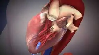 Edwards SAPIEN Transcatheter Heart Valve with the Ascendra Transapical Delivery System