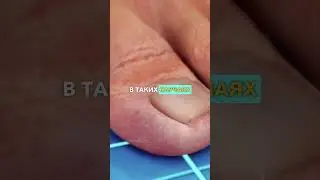 Ноготь ВРОС В Палец 😨 (что делать) ✨ 