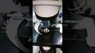 UTI under the microscope. Urinary Tract Infection PUS Cells. White blood cells 