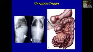 Острое нарушение проходимости желудочно кишечного тракта