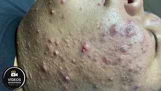 Very Satisfactory | Removal of blackheads and pimples 😱
