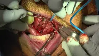 Partial Glossectomy with Primary Transverse Closure
