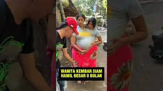 Bumil Kembar Siam Hamil Besar 8 bulan