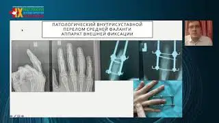 Травма суставов и костей конечностей: клиника и лечение