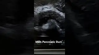 Main Pancreatic Duct | Ultrasound