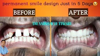Teeth Gap ?  Don't worry Teeth gap close in 5 Days ||Zirconia crowns |Emax crowns |Midline diaestma