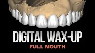 DIGITAL WAX-UP Full Arch Upper Jaw