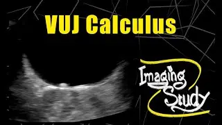 Vesicoureteric Junction (VUJ) Calculus || Ultrasound || Case 72