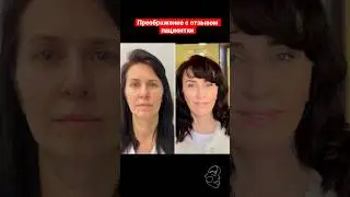 Голливудский фейслифтинг. Подтяжка лица. Пластический хирург Татьяна Романовская